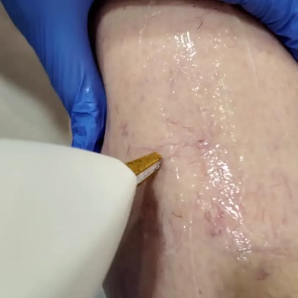 Como-quitar-aranas-vasculares-con-laser-vascular-vasculaze