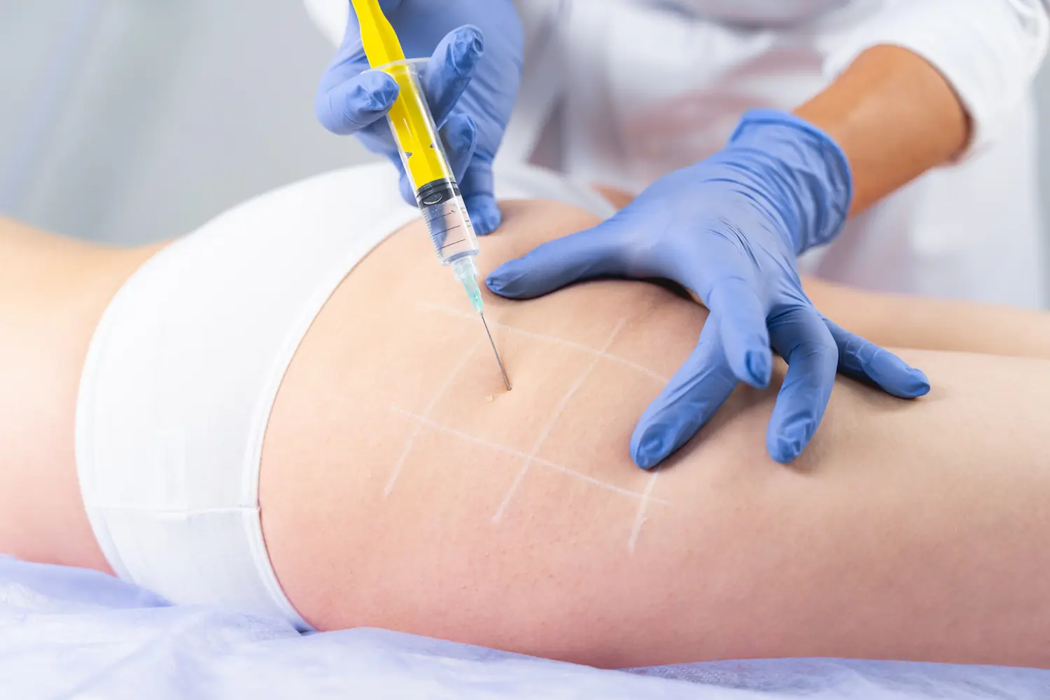 Mesoterapia
